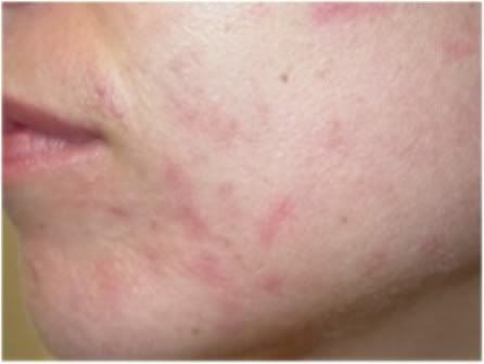 Types Of Acne Scars Erythema acne scars