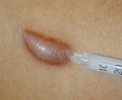 Steroid injection for Keloid - Dermatology - MedHelp