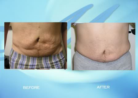 mesotherapy-before-and-after