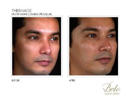 thermage before after. Thermage Before and After by